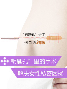 钥匙孔”里的手术,解决女性私密困扰!